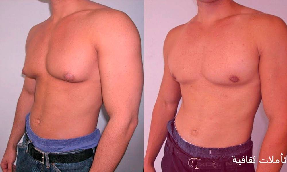 Гинекомастия в бодибилдинге