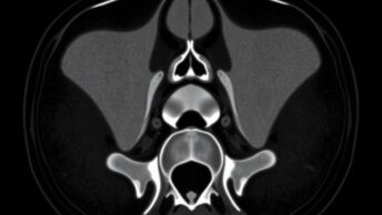 КТ копчика: когда нужно, как делают и что показывает исследование