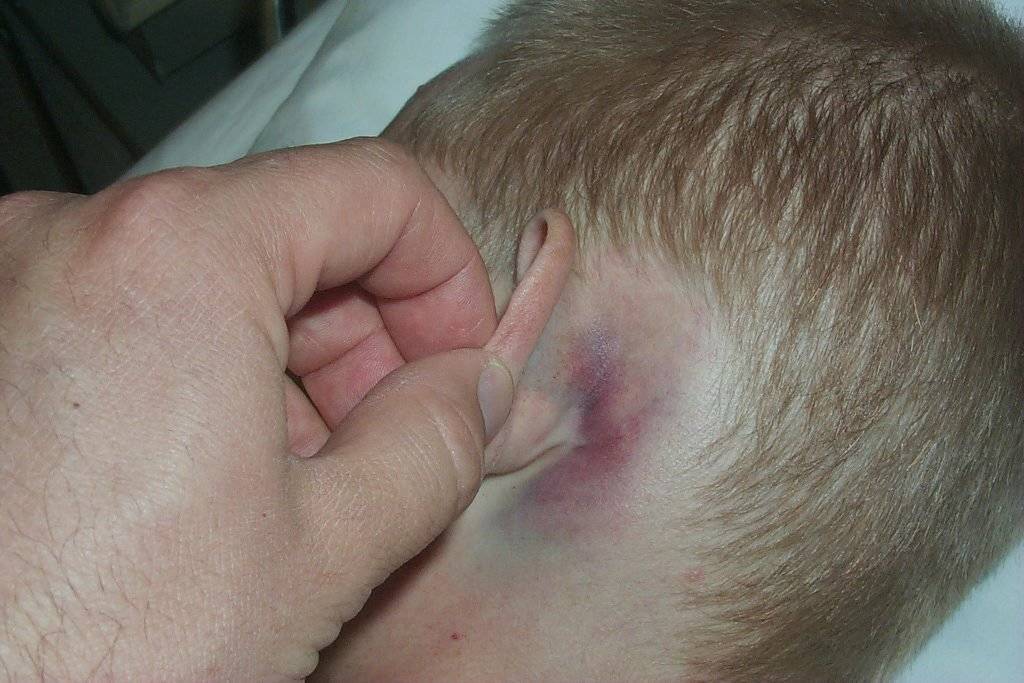 Воспаление лимфоузлов на шее: симптомы, почему болят лимфатические узлы, что делать, чем и как лечить