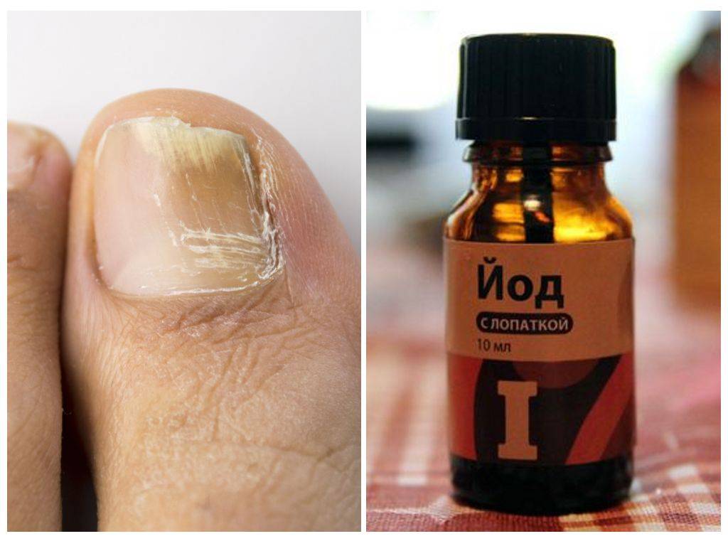 Грибок ногтей на ногах: чем лечить, народные средства, как вылечит грибок и причины появления