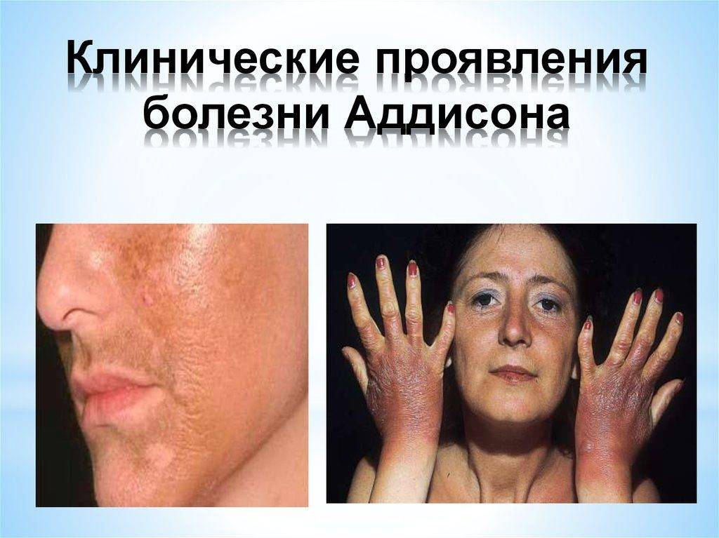 Гормон Кортизол