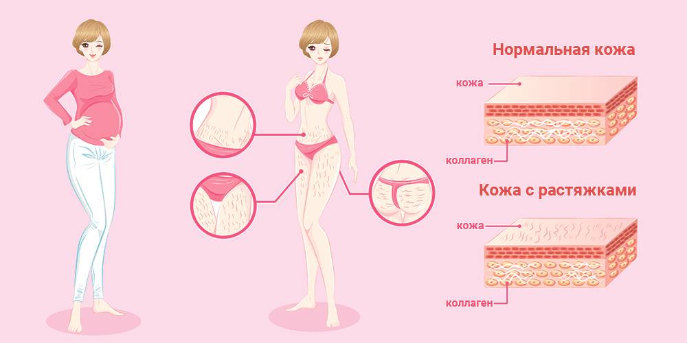 Почему у одних нет растяжек, но это не их заслуга, а вы не виноваты в своих?