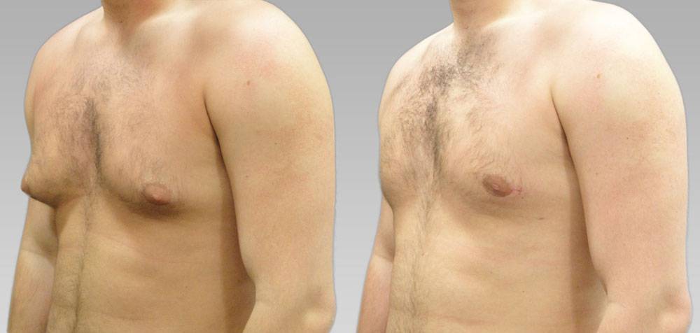 Гинекомастия в бодибилдинге