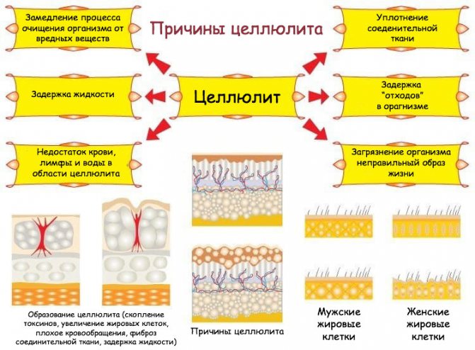 Основные причины появления целлюлита. почему появляется целлюлит у женщин